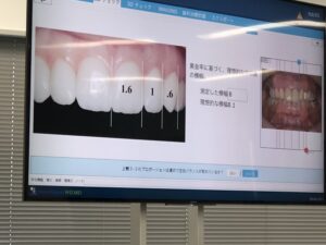 インビザラインのご相談はお気軽にお問い合わせください.0166-27-2450 旭川駅前あしたばデンタルクリニックのマウスピース矯正～インビザラインは透明なマウスピースを取り換えながら矯正治療をします。日常の生活に支障をきたすことがないマウスピース矯正で、衛生的に保つことも可能です。遠隔で矯正治療の状況を把握するシステムも充実していますので、旭川市外からも多くの方が利用されている治療です。