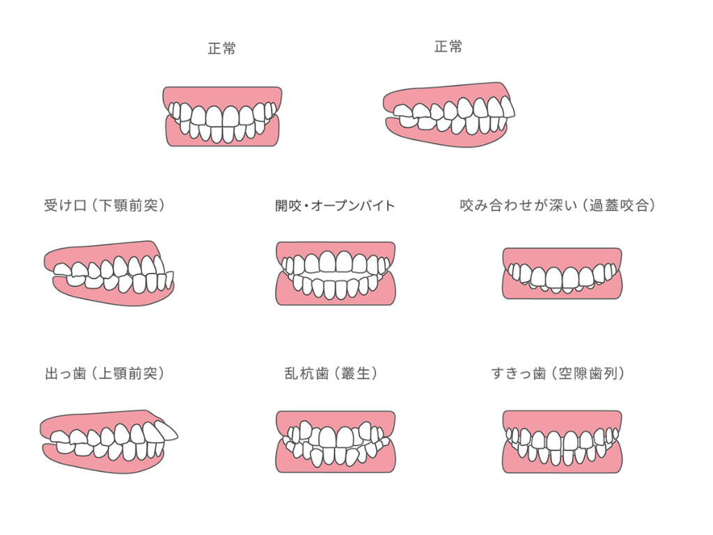 悪い歯並び